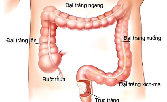 Vị trí đau đại tràng, nhận diện điều này ngay? 