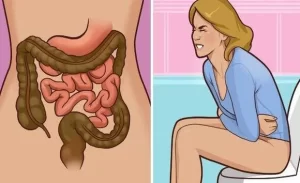 FTT_Ung thư đại tràng, biến chứng nguy hiểm của viêm đại tràng