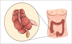 FTT_Phân biệt đau bụng thường và viêm ruột thừa