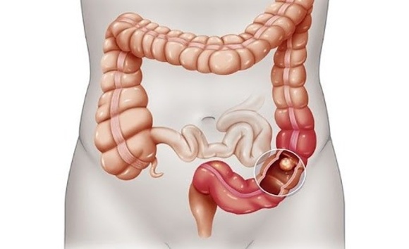 Viêm trực tràng và những dấu hiệu cơ thể đang phát tín hiệu 