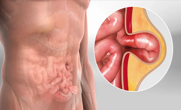 Tắc ruột là gì? Hiểu đúng để bảo vệ sức khỏe đường ruột 