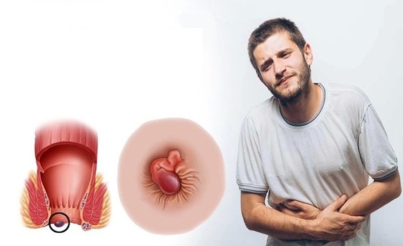 Trĩ nội, trĩ ngoại, trĩ hỗn hợp: phân biệt dễ dàng, điều trị hiệu quả