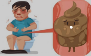 FTT_Hẹp đại tràng