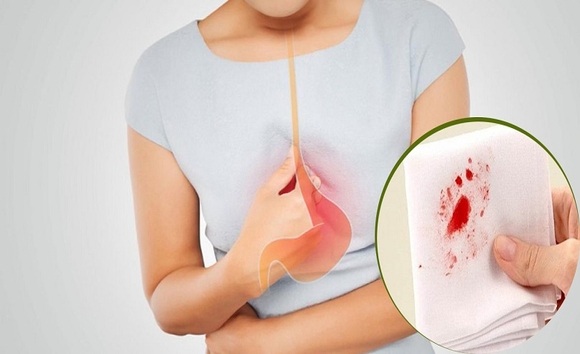 Nôn ra máu – cảnh báo của những bệnh tiêu hóa nguy hiểm