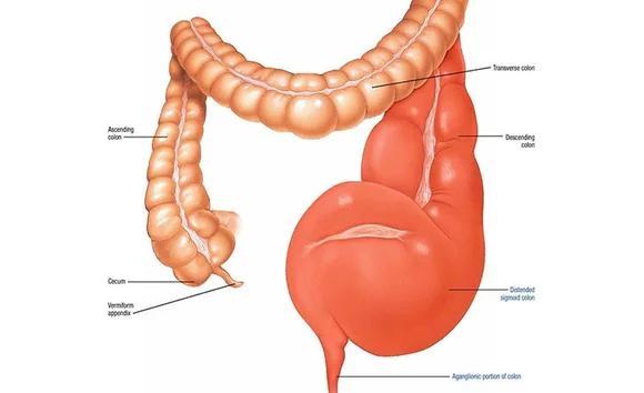 Phình đại tràng là gì? Dấu hiệu nhận biết và khi nào cần gặp bác sĩ 