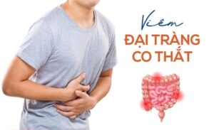 FTT_Viêm đại tràng co thắt là gì?