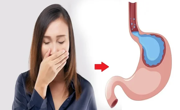 Vì sao trào ngược dạ dày lại gây ho? Lý giải từ chuyên gia 