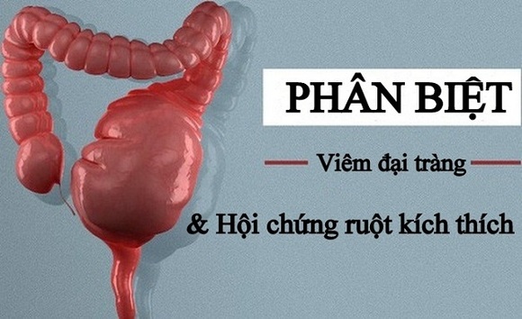 IBS và viêm đại tràng: Làm sao phân biệt chính xác?