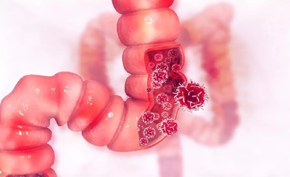 Viêm đại tràng lâu năm có thể gây ra những biến chứng nào?