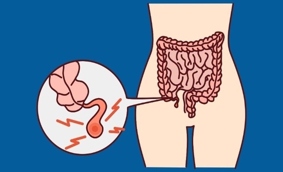 Viêm ruột thừa là gì? Triệu chứng, cách nhận biết và điều trị hiệu quả
