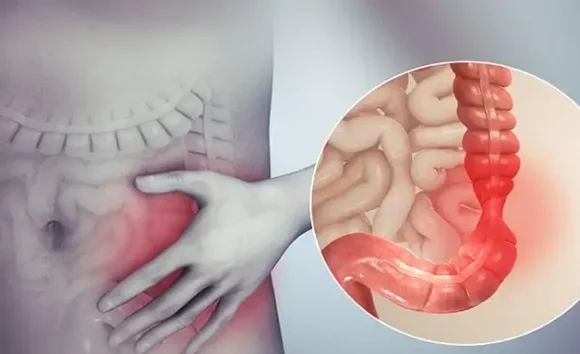 Đau bụng dưới bên trái: cảnh báo viêm đại tràng?