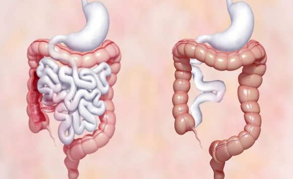 Tìm hiểu về hội chứng ruột ngắn: Khi cơ thể không hấp thu đủ chất