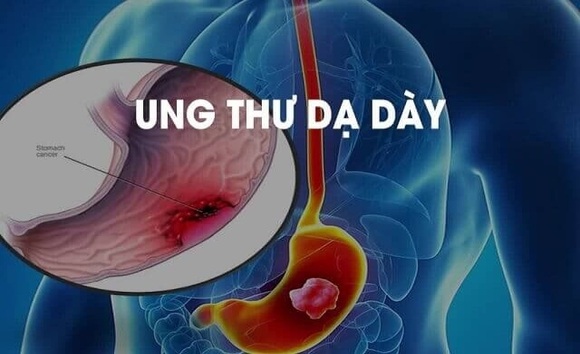 10 triệu chứng cảnh báo ung thư dạ dày thường bị nhầm lẫn 