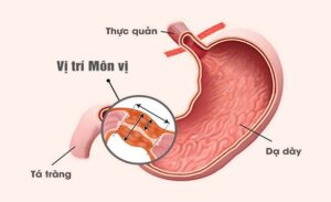 FTT_Hẹp môn vị là gì?