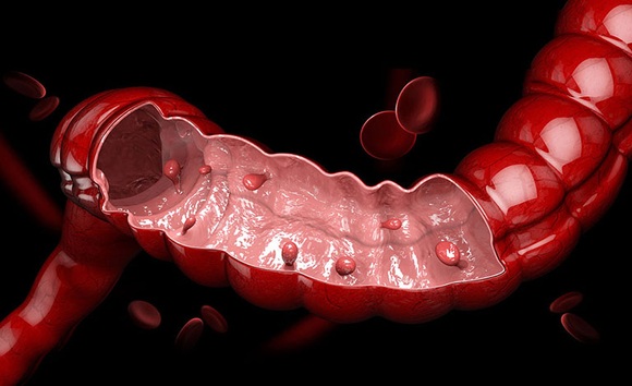 Tổng quan các loại polyp đại tràng: Lành tính hay nguy hiểm?