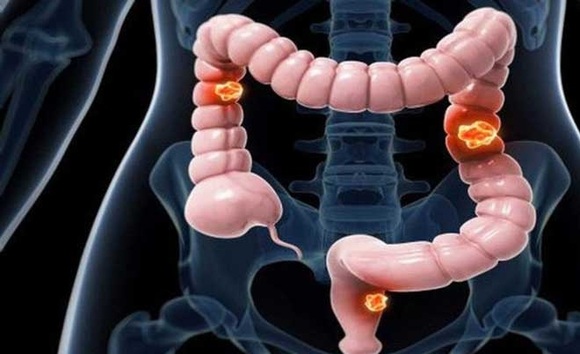 Áp xe đại tràng: Dễ bị nhầm lẫn với trúng gió, nhưng hậu quả thì không nhẹ