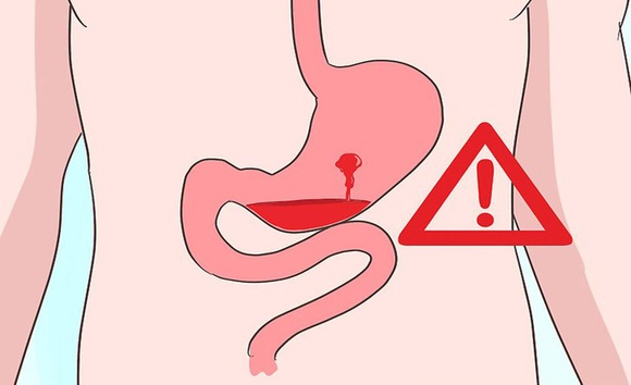 Xuất huyết dạ dày: Dấu hiệu nhận biết sớm & cách xử lý kịp thời