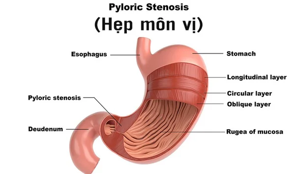 Hẹp môn vị có nguy hiểm không? Cách phát hiện và điều trị