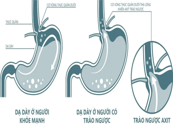 FTT_Acid dịch vị là gì? Vai trò với tiêu hóa và khi nào cần kiểm soát