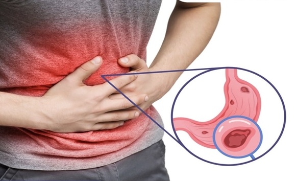 5 dấu hiệu niêm mạc dạ dày bị tổn thương và cách xử lý