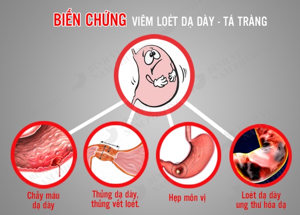 FTT_Khi yếu tố bảo vệ bị phá vỡ: Nguy cơ viêm loét, xuất huyết và ung thư dạ dày