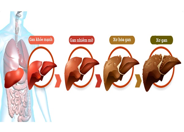 FTT_Gan làm việc 24/7: Bạn có đang vô tình khiến gan kiệt sức?