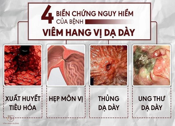 FTT_Các giai đoạn tiến triển của loét hang vị và biến chứng nguy hiểm