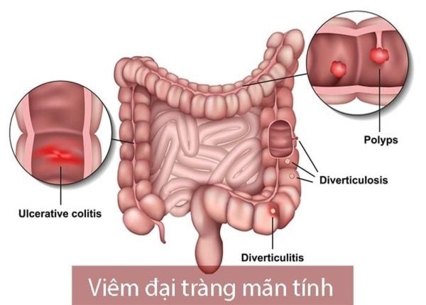 FTT_Thực phẩm sống: “kẻ thù” Âm thầm của đại tràng viêm mãn tính