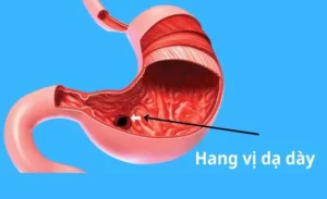 FTT_Các giai đoạn tiến triển của loét hang vị và biến chứng nguy hiểm