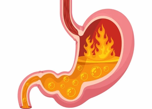 FTT_Tăng acid dịch vị: nguyên nhân, triệu chứng và cách xử lý an toàn