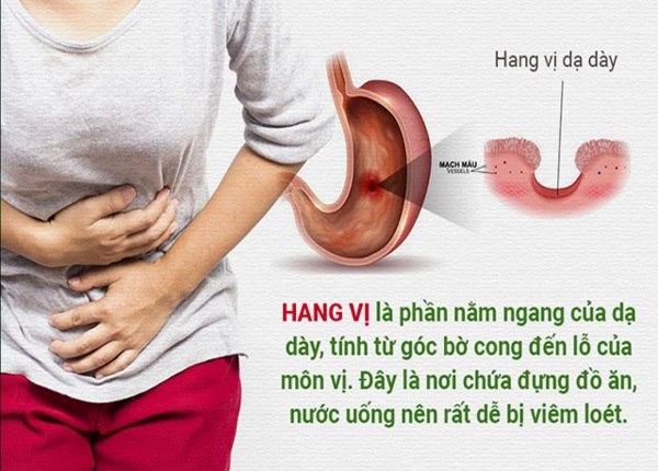 FTT_Vì sao hang vị dạ dày dễ bị loét hơn các vị trí khác?