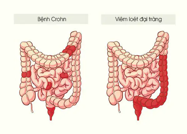 Bệnh Crohn có nguy hiểm không? Những điều cần lưu ý